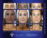 SWiCH Dermal Rejuvenation