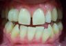 Appledore Treatment 1 Before