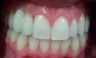 Appledore Treatment 1 After