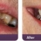 Porcelain Veneers Treatment