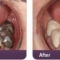 White Fillings Treatment