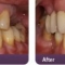 Ceramic Crowns Treatment