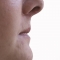 Before lip filler