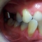 Appledore Treatment 2 Before