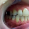 Appledore Treatment 2 After