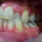 Appledore Treatment 3 Before