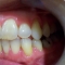 Appledore Treatment 3 After