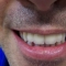 Appledore Dental Implants Can You See Which Teeth ?
