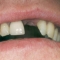 Appledore Dental Implant Before 1