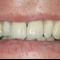 Appledore Dental Implant After 1