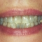 Appledore Veneers Before 1