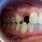 Appledore Treatment Before Dental Implant 2