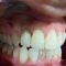 Appledore Treatment After Dental Implant 2