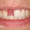 Dental Implants Before