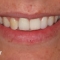 Dental Implants Before