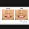 Restylane before and after