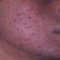 TCA skin peel