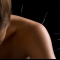 ASC Acupuncture Manchester - Shoulder Acupuncture