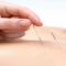 Medical Acupuncture