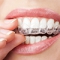 Invisible braces