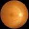 retinal photography