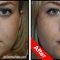 Lip Enhancement from just £199