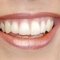 Smile, tooth whitening, cosmetic dentistry