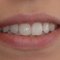 smile, tooth whitening, cosmetic dentistry